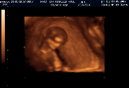 First Image of the Baby